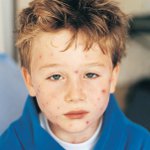 Molluscum contagiosum in children Molluscum contagiosum in children