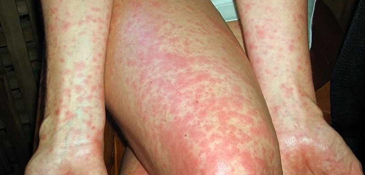 scarlet fever in children photo