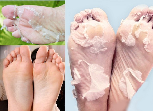 Cream of calluses and corns
