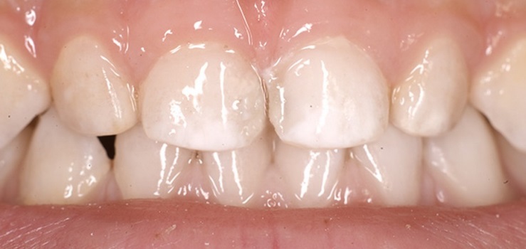 How to deal with white spots on the teeth