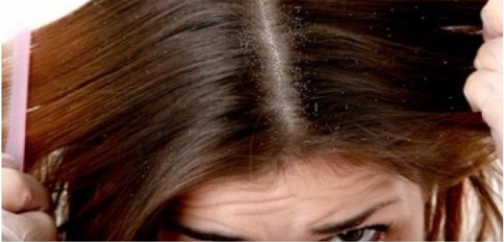 hair with dandruff