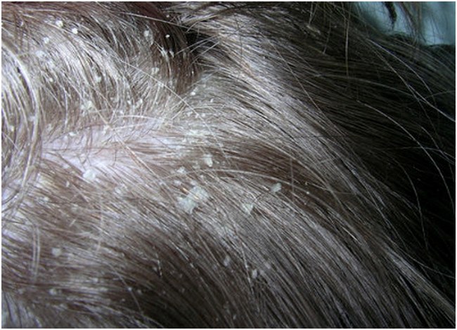 a lot of dandruff