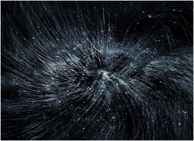 dandruff on the hair
