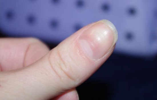 Cuticle Removal