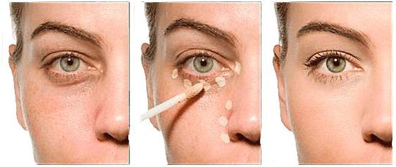 Permanent make-up for hiding bruises under the eyes
