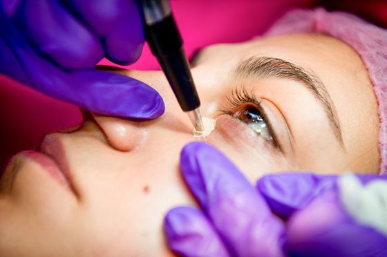 Permanent make-up for hiding bruises under the eyes