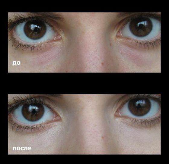 Permanent make-up for hiding bruises under the eyes