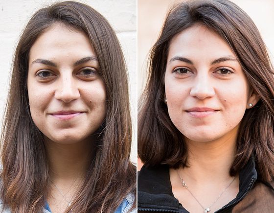 Permanent make-up for hiding bruises under the eyes