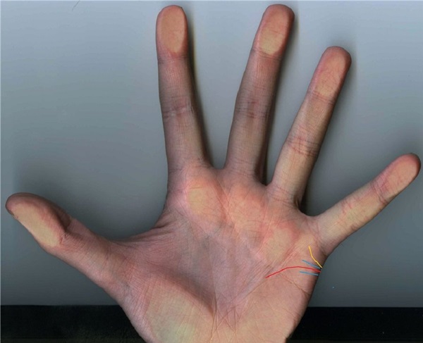 The marriage line on the hand