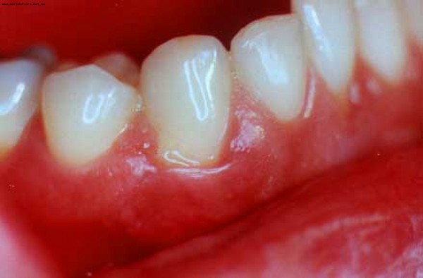 What itches - the gums or teeth? Why does it scratch the gums in adults? How to get rid of discomfort?