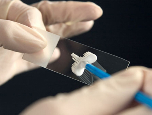 What do the cocci in the smear mean?