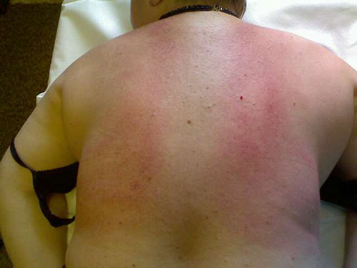 Should bruises remain after the massage