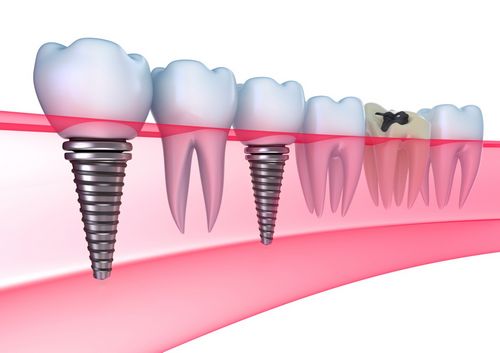 Is dental implantation a luxury or a necessity? 