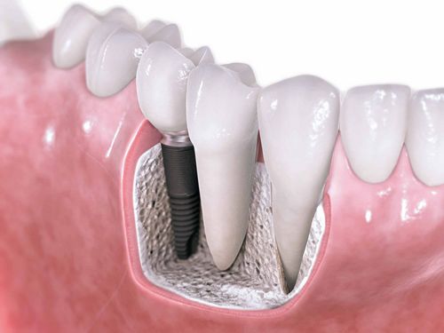 Is dental implantation a luxury or a necessity? 