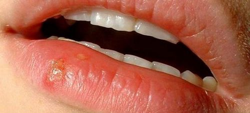 recipes for treating colds on the lips