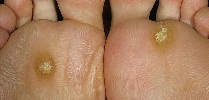 Problems with corns and calluses? Look for the solution here!
