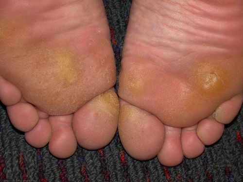 Problems with corns and calluses? Look for the solution here!