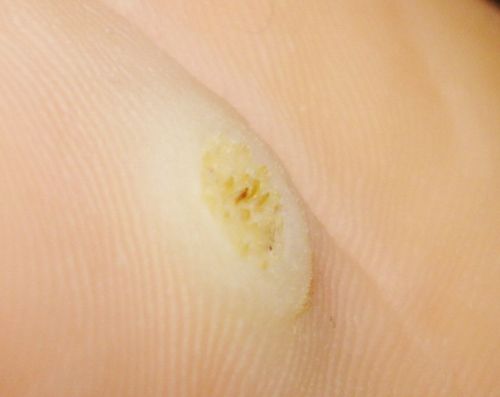 Problems with corns and calluses? Look for the solution here!