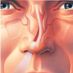 How to treat the curvature of the nasal septum: surgery, laser correction