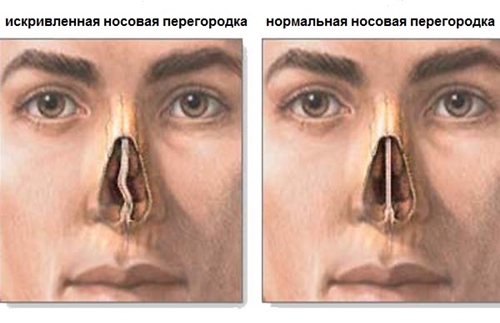How to treat the curvature of the nasal septum: surgery, laser correction