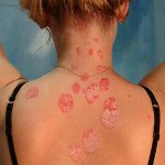 How to treat psoriasis? How to treat psoriasis?