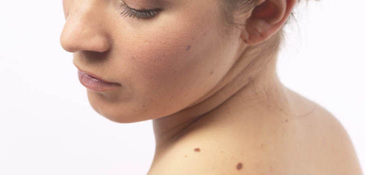 How to prevent the appearance of moles