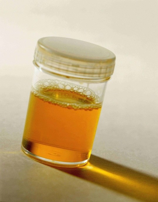 urine in a jar