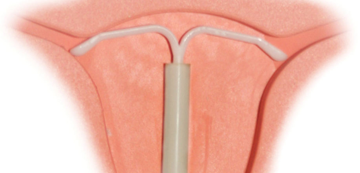 Is it possible to put an intrauterine device for nulliparous women