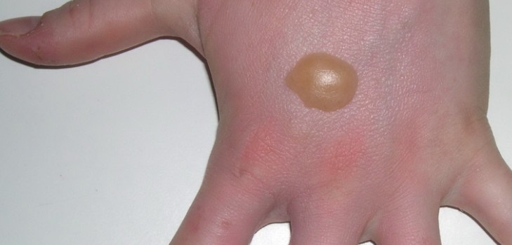 Watery bubbles appeared on the palms of your hands: what to do