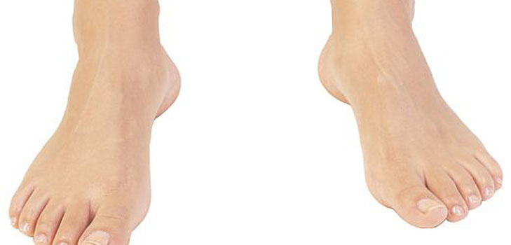 Strongly sweaty feet. What to do?