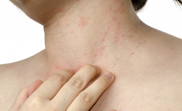 Rashes in adults: photos, the causes of rashes and tips for the treatment of skin rashes