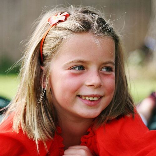 Dark circles under the eyes of a child: prevention measures