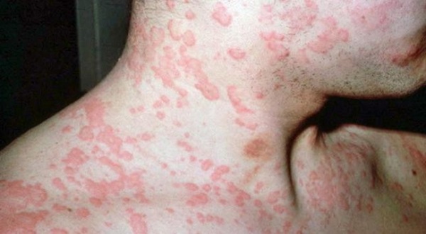 Insect bites