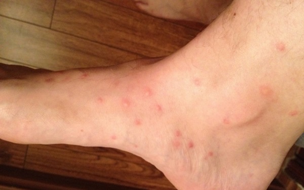 Insect bites