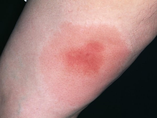 Insect bites