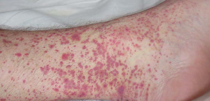 Vasculitis - what is it? Symptoms, photos, treatment